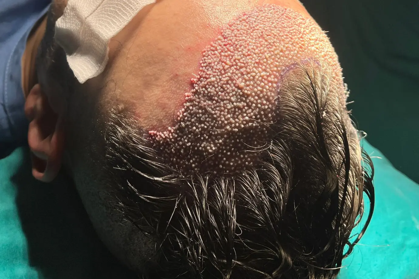 زراعة الشعر بتقنية DHI