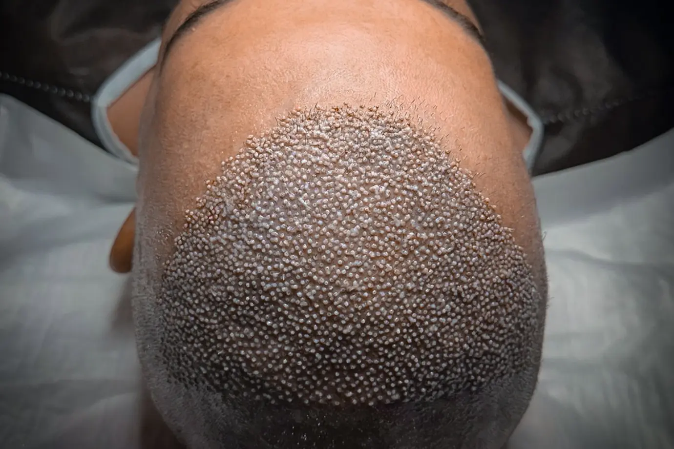 زراعة الشعر بتقنية Sapphire