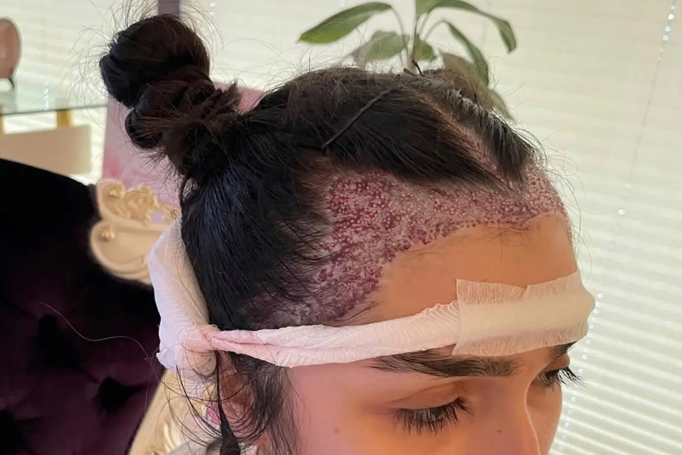 زراعة الشعر للنساء