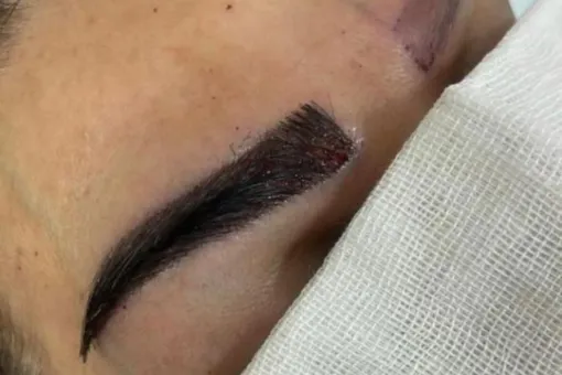 Choosing the Right Eyebrow Transplant Technique