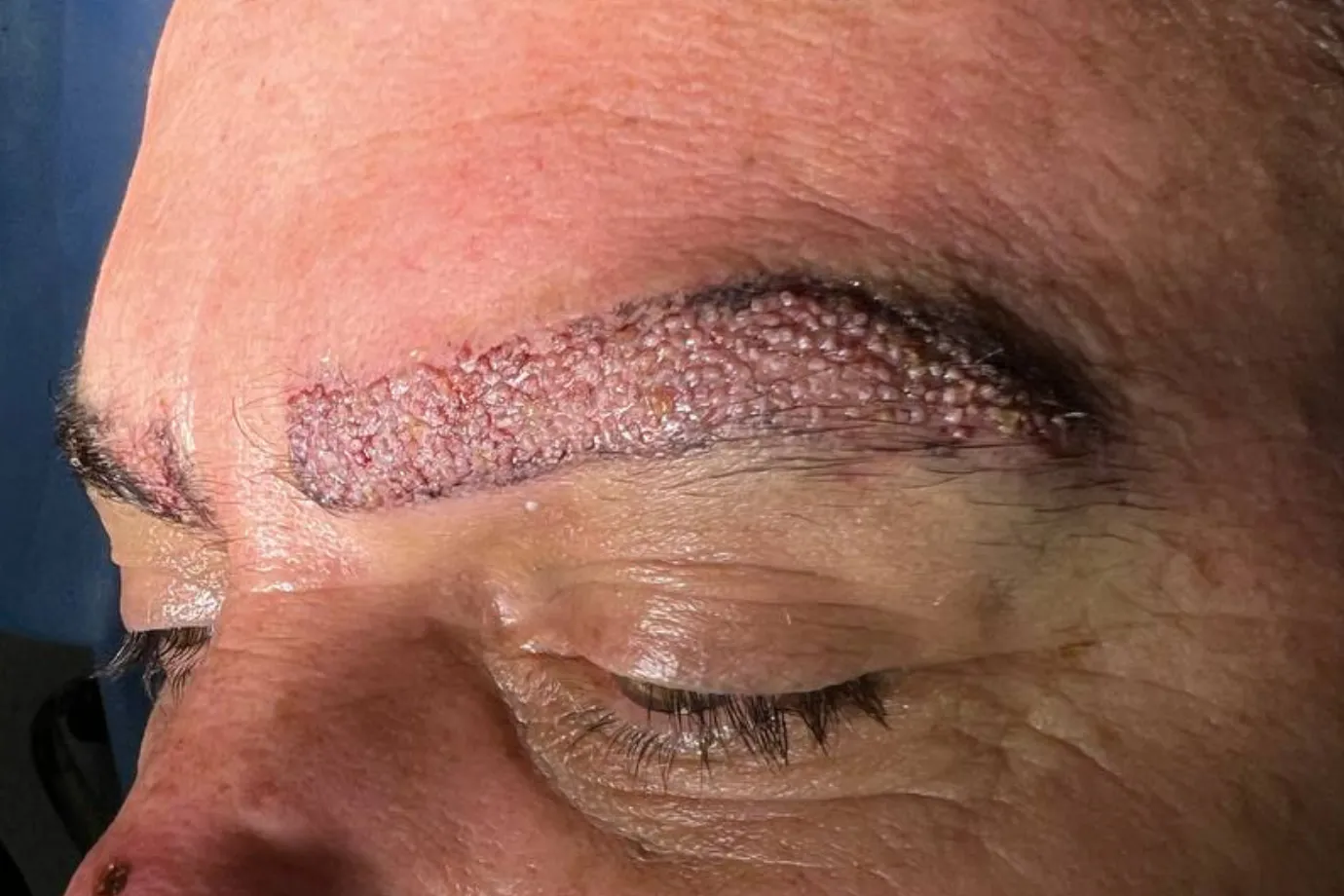 Art of Eyebrow Transplant in Istanbul 