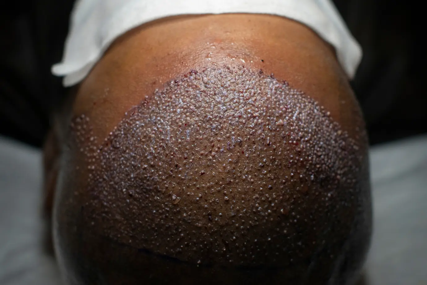 زراعة الشعر الأفريقي