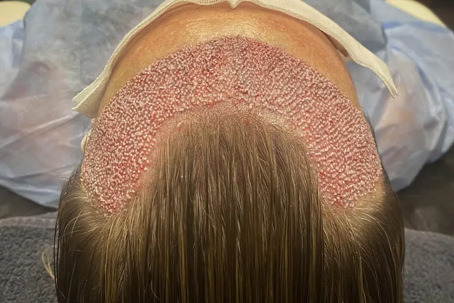 زراعة الشعر للنساء