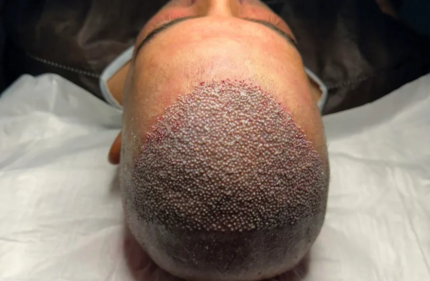 Art of Sapphire Hair Transplant in Istanbul