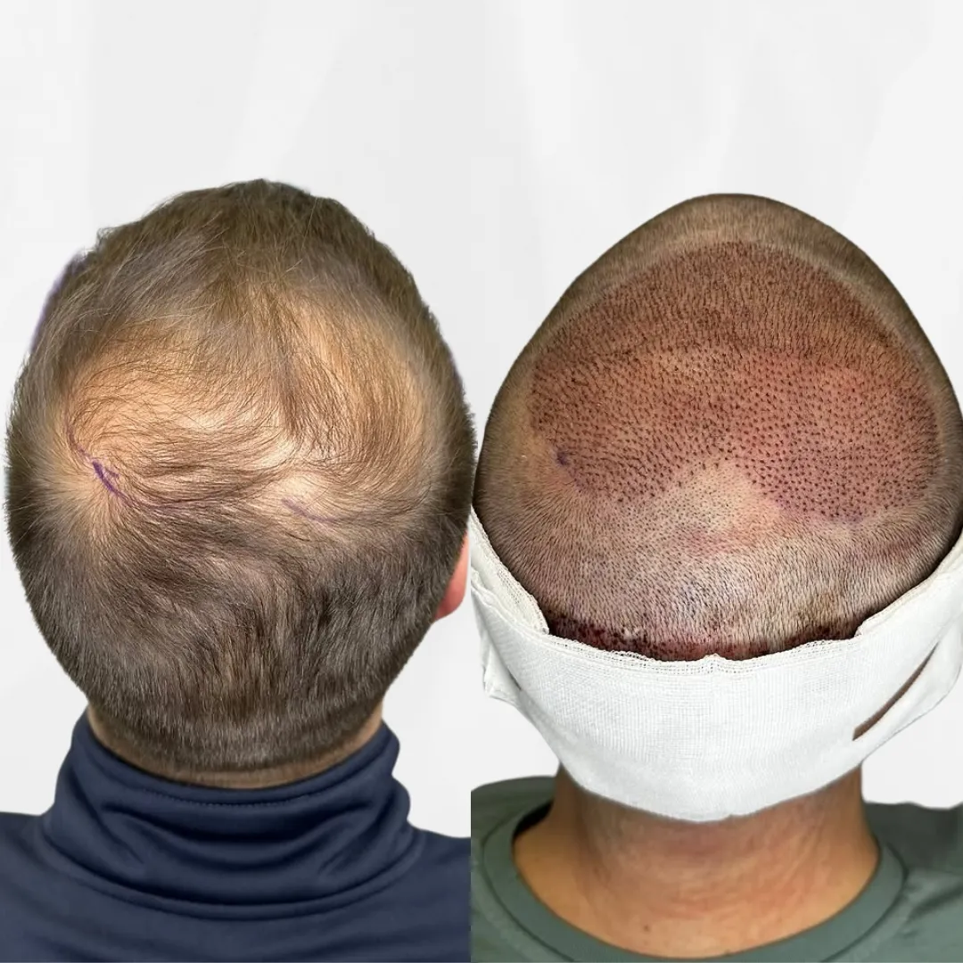 Higher Density & Natural Results