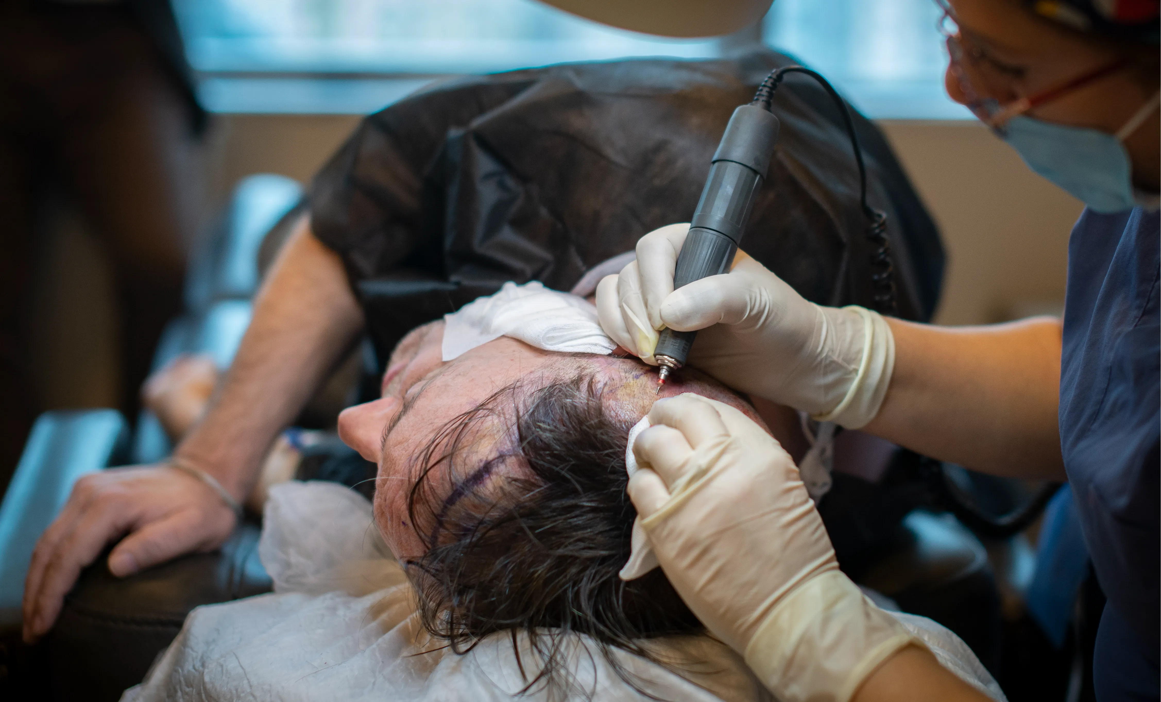 فن زراعة الشعر بتقنية DHI في إسطنبول