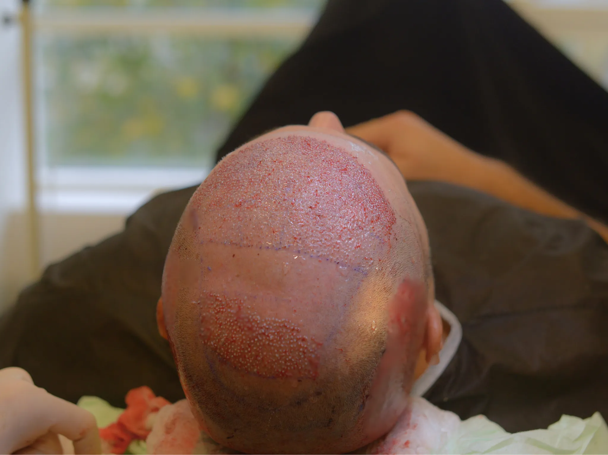 زراعة الشعر للرجال في اسطنبول: دليلك الشامل قبل أن تفقد المزيد من شعرك