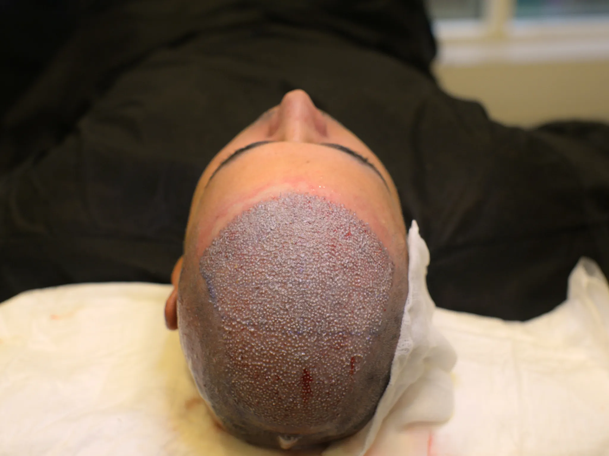 زراعة الشعر الهجين في إسطنبول: دمج لأحدث تقنيات زراعة الشعر 