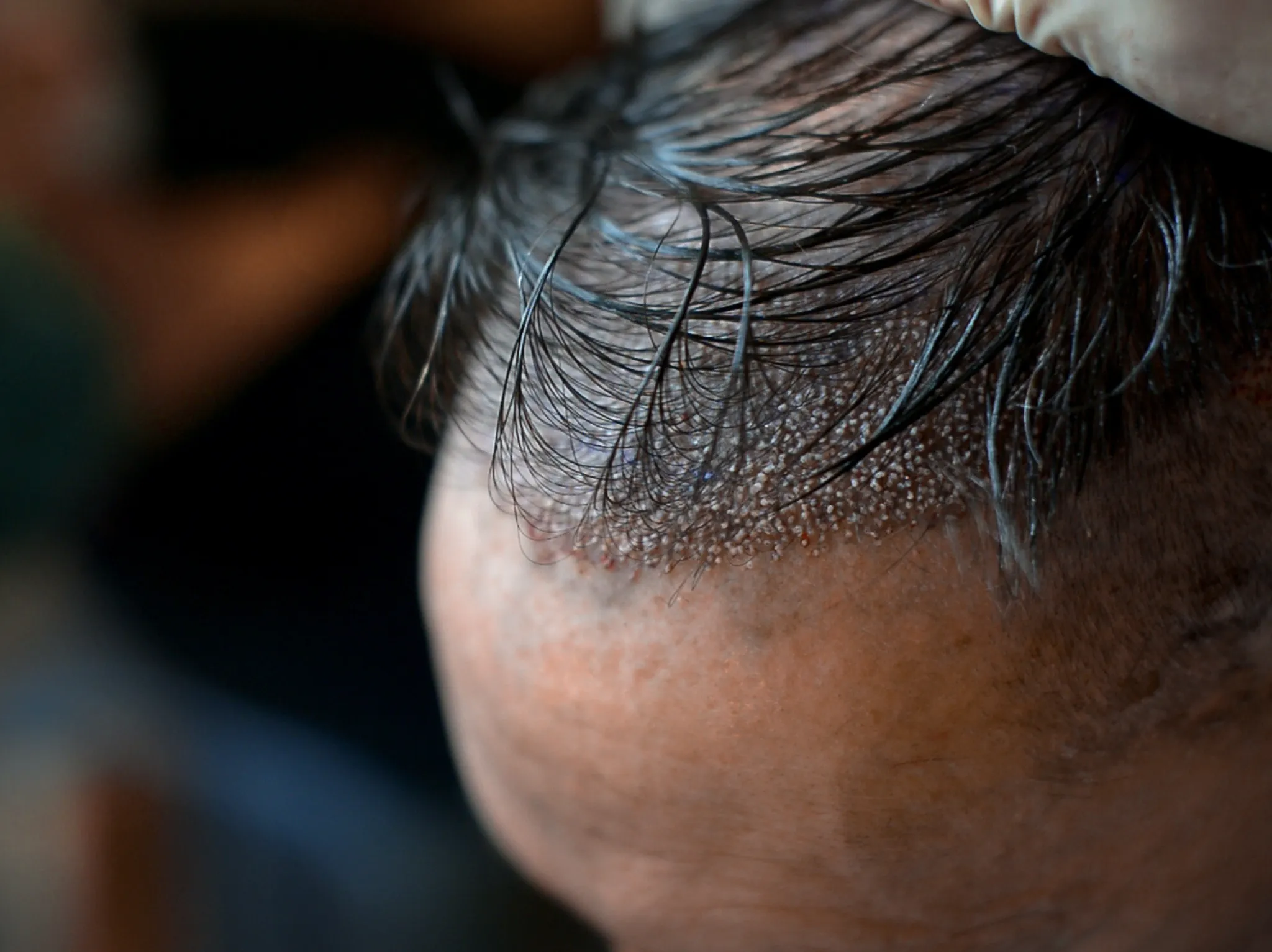 Hair transplant without shaving in Istanbul: Keep Your Hair, Gain More!
