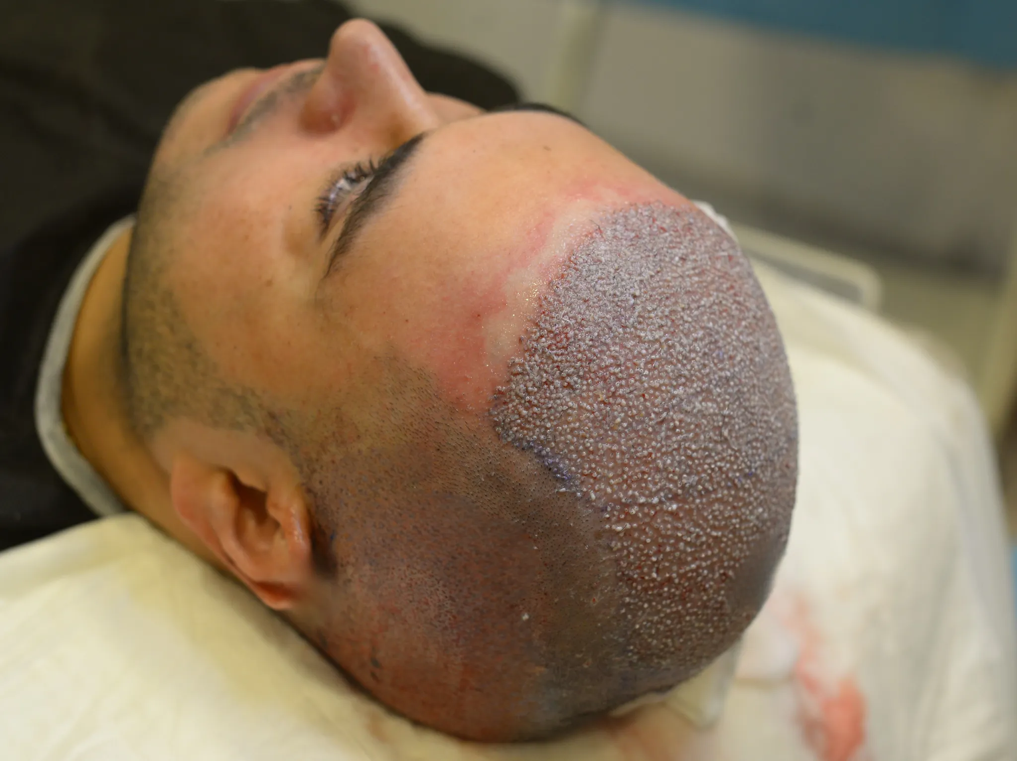 تكلفة زراعة الشعر في إسطنبول: إليك ما لا يخبرك به أحد عن الأسعار
