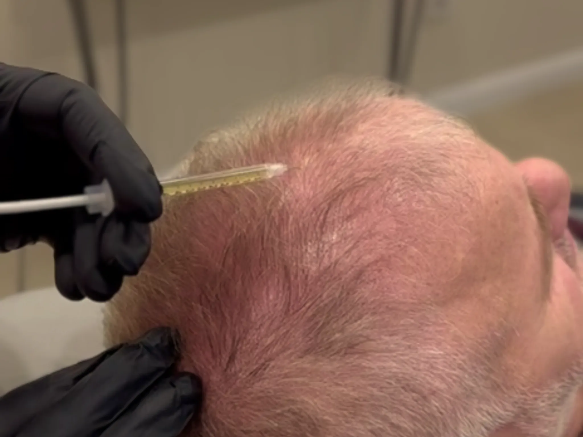 PRP hair treatment in Istanbul: non-surgical guide to treating hair loss