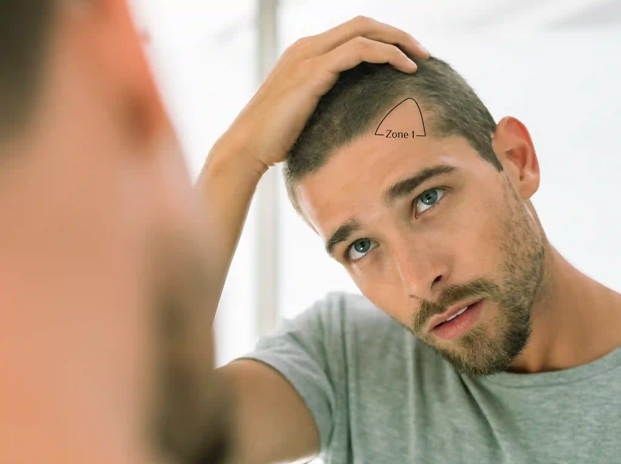 Norwood Hair Loss Scale: Stages and How to Regain Your Confidence?