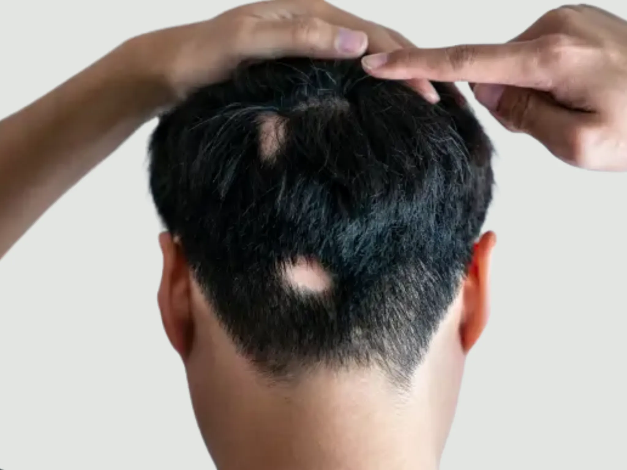 Types of hair loss: An overview of Alopecia treatment in Istanbul 2025