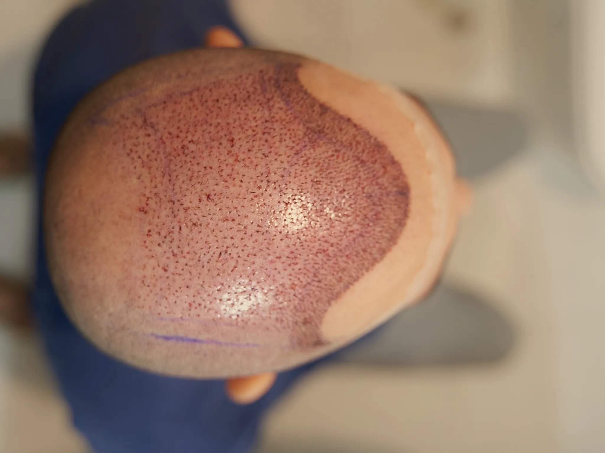 إصلاح زراعة الشعر الفاشلة في إسطنبول: لنستعيد الأمل من جديد