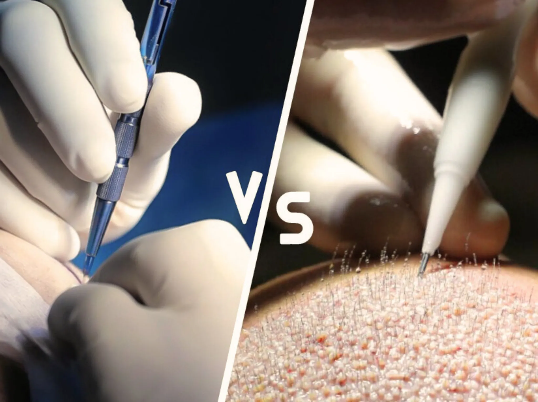 Differences Between Choi Pen and Sapphire in hair transplant Istanbul