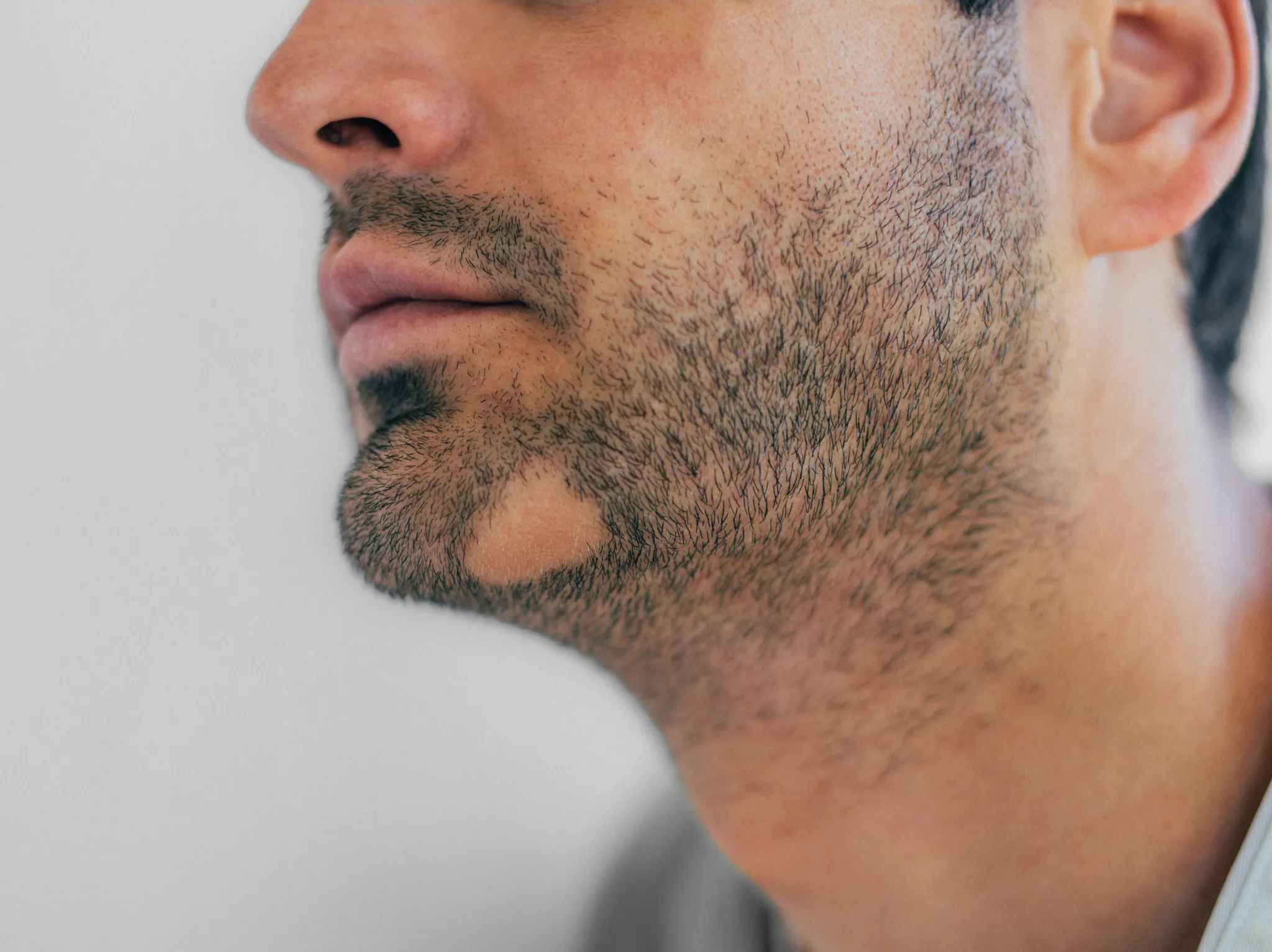 Discover What is the Best Alopecia Barbae treatment in Istanbul 2025?
