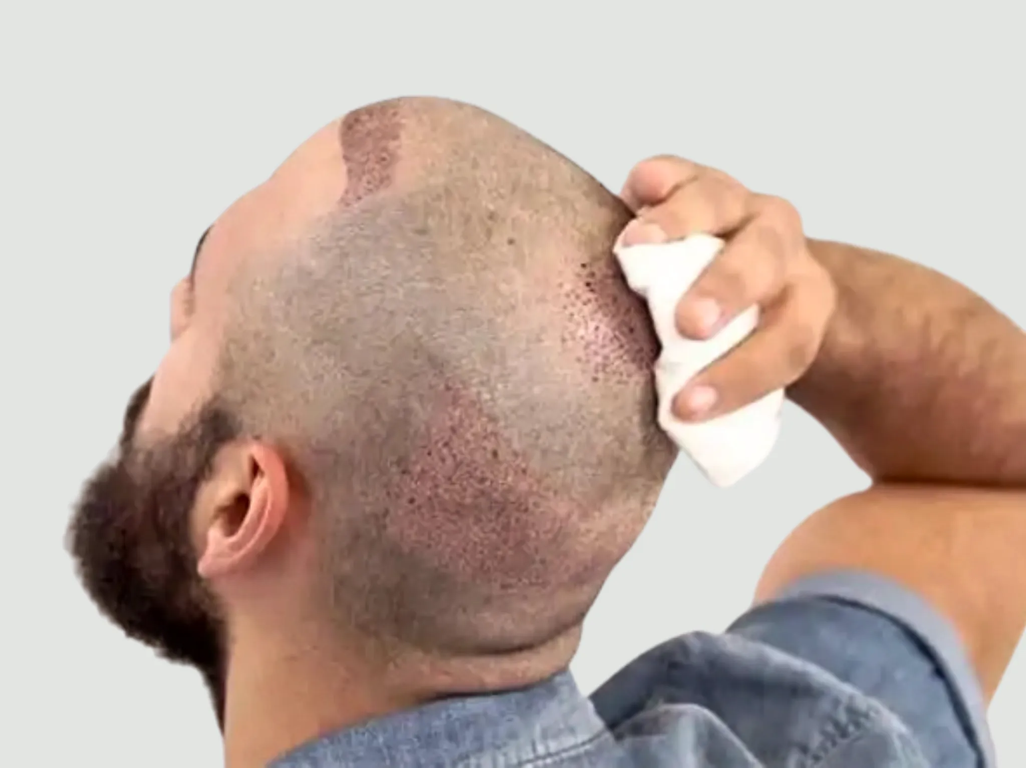 تساقط الشعر بعد زراعة الشعر: مرحلة مؤقتة أم مصدر قلق؟